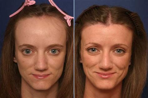Hairline Lowering Surgery, Before and After