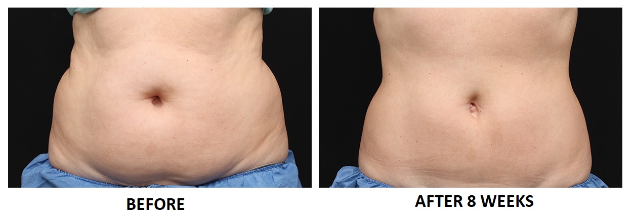 Before and 8 Weeks After CoolSculpting