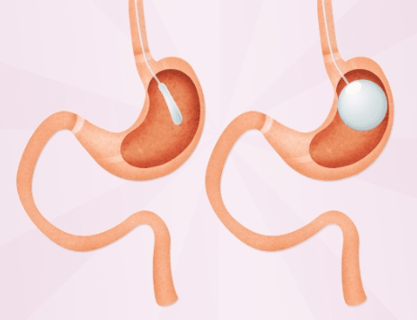 Pros and Cons of a Gastric Balloon