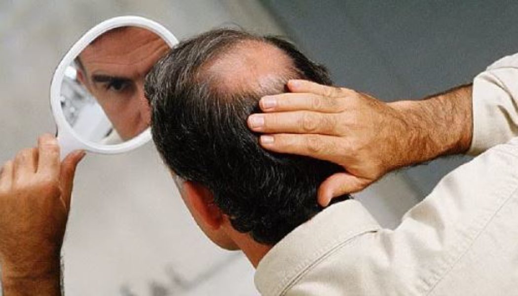 Hair Transplant Procedure to cover bald patches