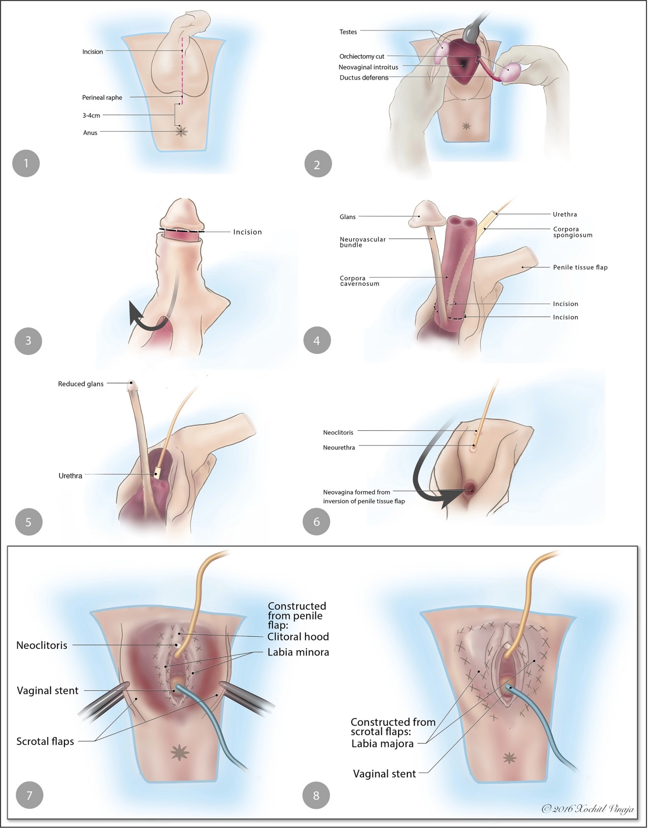 Vaginoplasty using penile skin graft