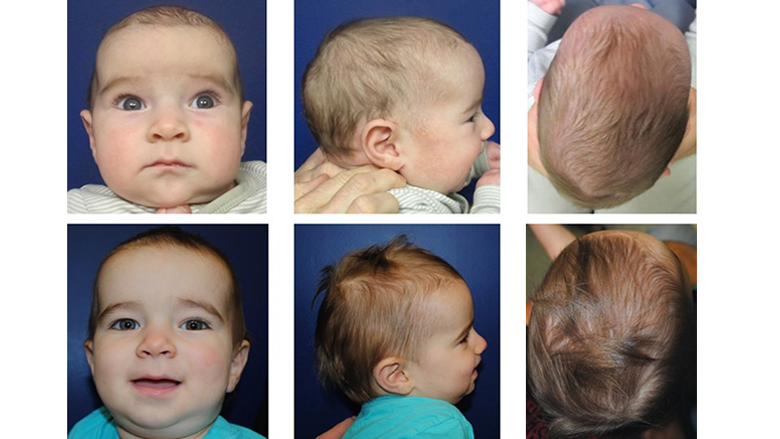 Cranioplasty in Children