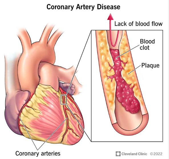 Coronary Artery Disease (CAD) Treatment