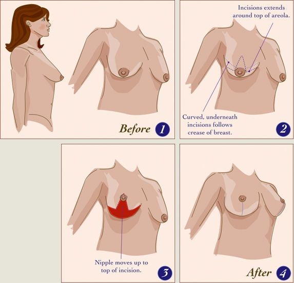 Breast Lift, Before and After