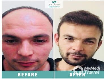 Women's Hair Transplant - Green DMC Travel Tour Agency