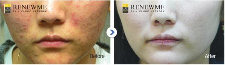 Compare Reviews, Prices & Costs of Hand Rejuvenation in South Korea at Renewme Skin Clinic | M-SO8-30