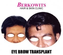 Berkowits Hair & Skin Clinic(Connaught Place)