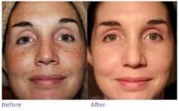 Compare Reviews, Prices & Costs of Acne Treatment in Telangana at skin aesthetique | M-IN7-12