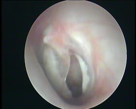 Compare Reviews, Prices & Costs of Dermal Fillers in Gurgaon at ENT, Head, Neck clinic and hearing aid centre | M-IN6-24