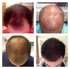 Compare Reviews, Prices & Costs of Hair Transplant in West Yorkshire at Better Hair Transplant Clinics - Leeds | M-UN1-541