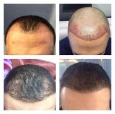 Better Hair Transplant Clinics - Leeds