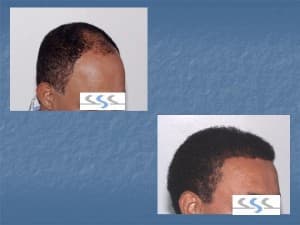 10 Best Clinics for Hair Transplant in Dominican Republic [2023 Prices]