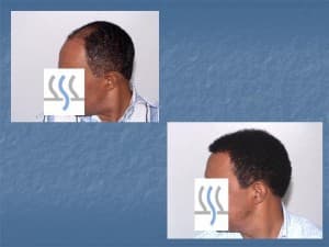 Hair Transplant Institute - Dr. Alba Reyes, MD
