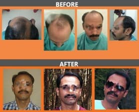 Dr. YV Rao Hair Transplant Clinic - Hyderabad - Medical Center in Telangana  | MyMediTravel