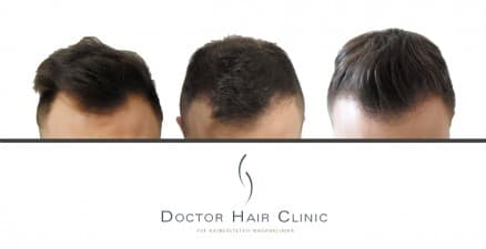 Compare Reviews, Prices & Costs of Hair Transplant in Hungary at Doctor Hair Clinic - FUE Hair Transplant Clinic Hungary | M-HU6-2
