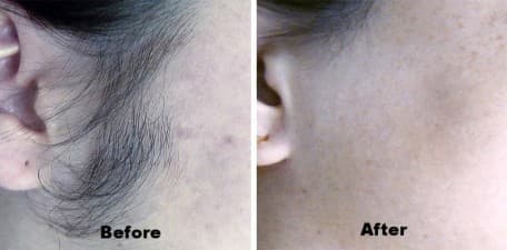 Compare Reviews, Prices & Costs of Laser Tattoo Removal in East Sussex at OFF Skin & Laser Clinic | M-UN1-553