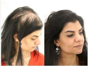 Compare Reviews, Prices & Costs of Hair Transplant in West Yorkshire at Want Hair | M-UN1-563