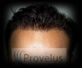 Provelus Hair Transplant Clinic