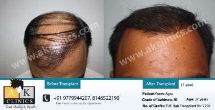 AK Clinics Pvt. Ltd Centre for Hair Transplant - Bangalore