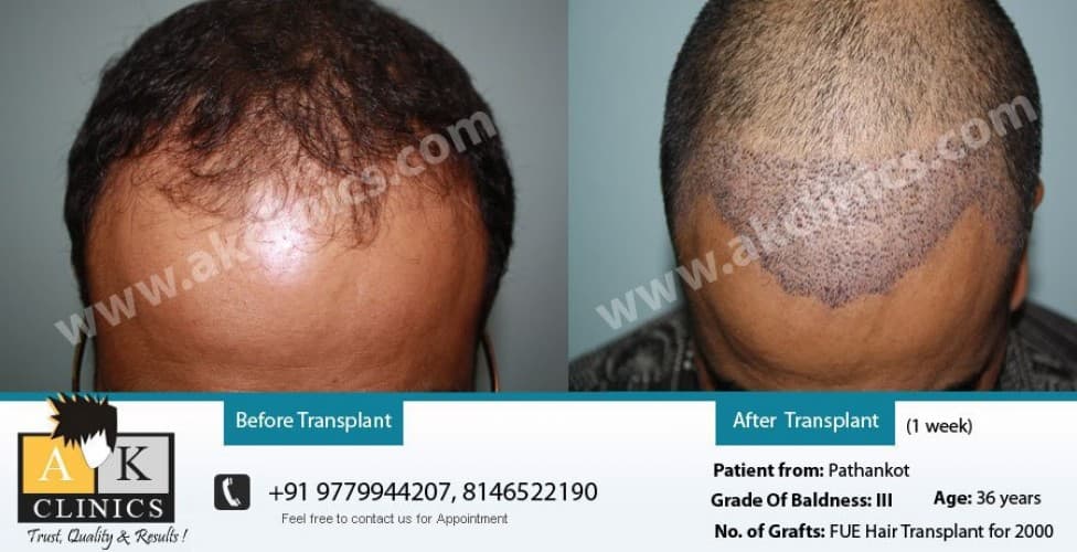 AK Clinics Pvt. Ltd Centre for Hair Transplant - Bangalore - Medical Center  in Bangalore | MyMediTravel