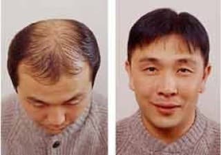 Compare Reviews, Prices & Costs of Acne Treatment in Hungary at Exoderm International Medical Centers - Sopron | M-HU1-53