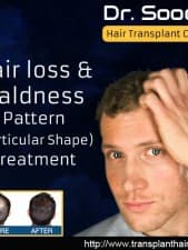 Compare Reviews, Prices & Costs of Beard Transplant in Delhi at Dr. Rakesh Sood | M-IN11-145