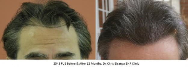 Bisanga Hair Restoration