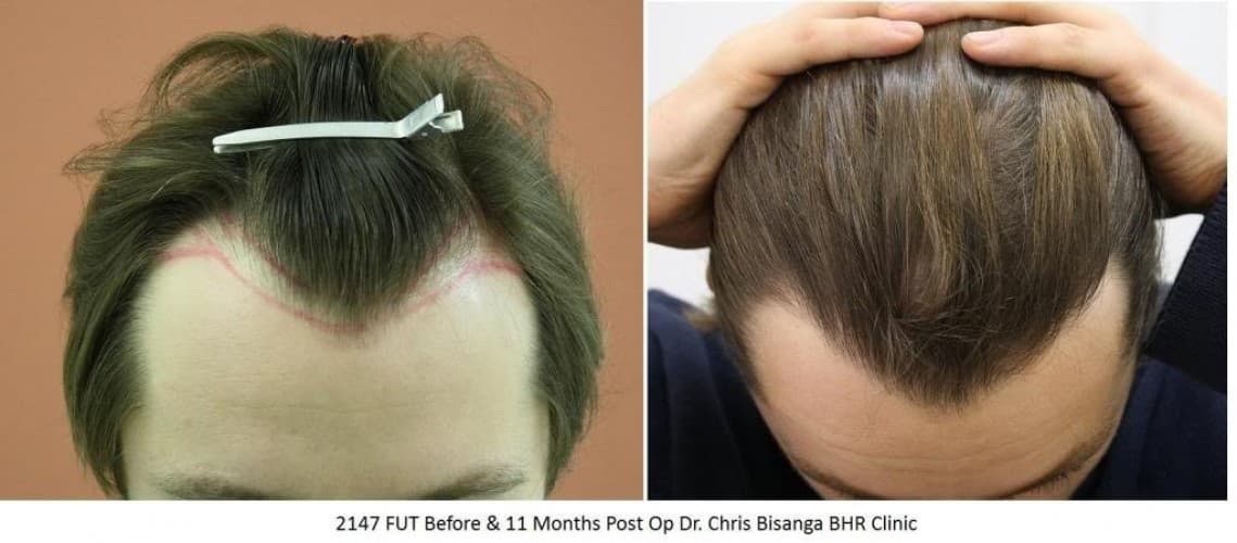 Bisanga Hair Restoration - Medical Center in Antwerp | MyMediTravel