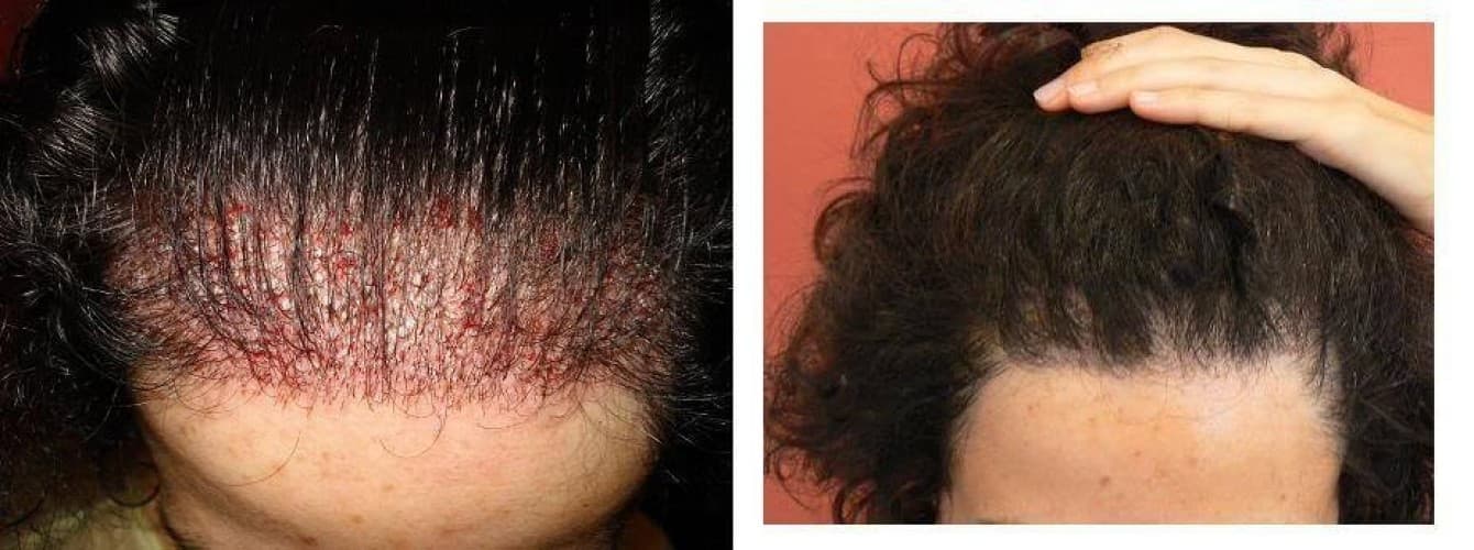 Bisanga Hair Restoration - Medical Center in Antwerp | MyMediTravel