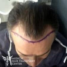 Medical Hair Transplant Center