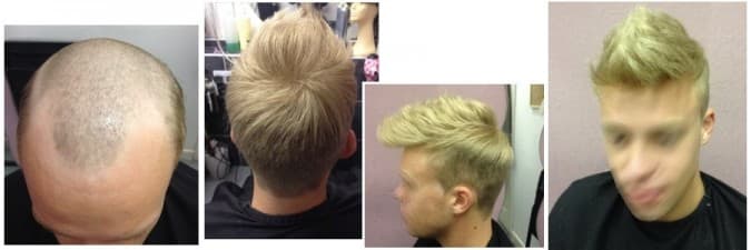 Compare Reviews, Prices & Costs of Hair Transplant in West Midlands at Hough Hair Loss Specialist | M-UN1-618