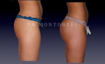 Compare Reviews, Prices & Costs of Eyebrow Hair Transplant in France at Dr Sebastiano Montoneri-Cosmetic and Plastic Surgery | M-FP2-15