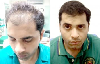 10 Best Clinics for Hair Transplant in Chennai [2023 Prices]
