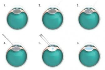 Compare Reviews, Prices & Costs of Glaucoma Treatment in West Midlands at Optegra Eye Health Care Birmingham | M-UN1-832