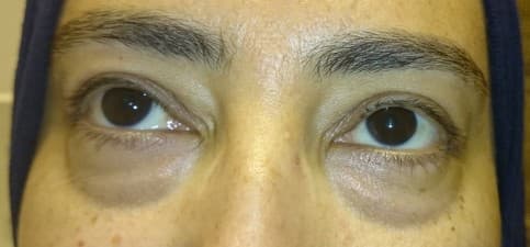 Compare Reviews, Prices & Costs of Double Eyelid Creation in Egypt at Dr. Ashraf Abolfotooh Plastic & Reconstructive Surgery Clinic | M-EG1-94