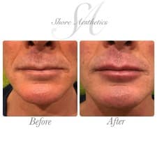 Compare Reviews, Prices & Costs of Cheek Augmentation in Dorset at Shore Aesthetics | M-UN1-1073