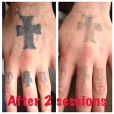 Compare Reviews, Prices & Costs of Microdermabrasion in Greater Manchester at The Missing Ink: Laser Tattoo Removal | M-UN1-1167