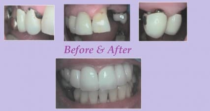 Compare Reviews, Prices & Costs of Dental Bridge in West Midlands at Lion Dental Centre | M-UN1-1225