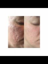 Compare Reviews, Prices & Costs of Chin Augmentation in Worcestershire at Lolica | M-UN1-1243