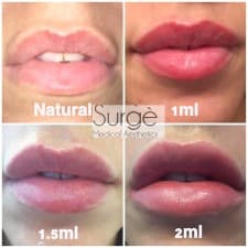 Compare Reviews, Prices & Costs of Dermal Fillers in Cheshire at Surge Medical Aesthetics | M-UN1-1244