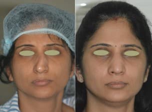 Rhinoplasty Clinic Bhatia Hospital