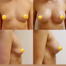 Compare Reviews, Prices & Costs of Double Eyelid Creation in Cyprus at Dr Kitsios Christos | M-CY1-72