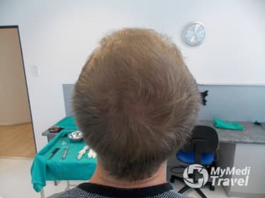 Medical Hair Restoration, Cape Town