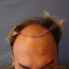 Star Hair Transplant