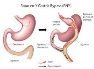 Compare Reviews, Prices & Costs of Laparoscopic Anti-Reflux (GERD) Surgery in Delhi at Delhiobesityclinic | M-IN11-228