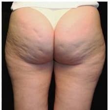 Compare Reviews, Prices & Costs of Buttock Liposuction in Portugal at Clínica Génese do Tempo, Lda | M-PP-1
