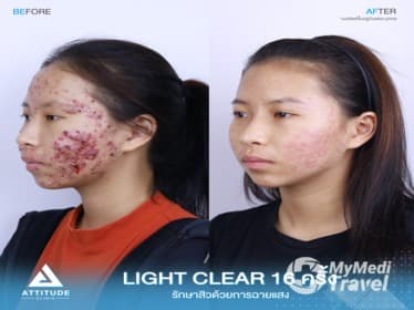 Compare Reviews, Prices & Costs of Acne Treatment in Chiang Rai at ATTITUDE CLINIC เชียงราย | DA576F