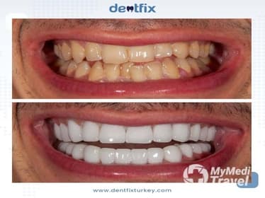 Compare Reviews, Prices & Costs of Dental X-Rays in Istanbul at Dentfix Turkey | A4BE77