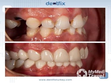 Dentfix Turkey