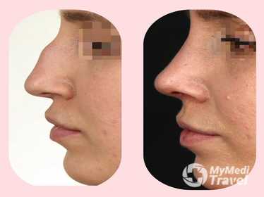 The Nose Aesthetic Clinic - Dr. Cem Altindag